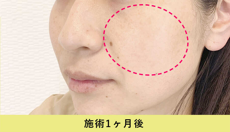 ピコスポット症例写真施術1ヶ月後