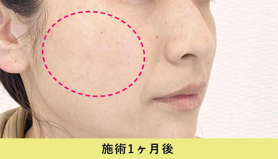 ピコスポット症例写真施術1ヶ月後