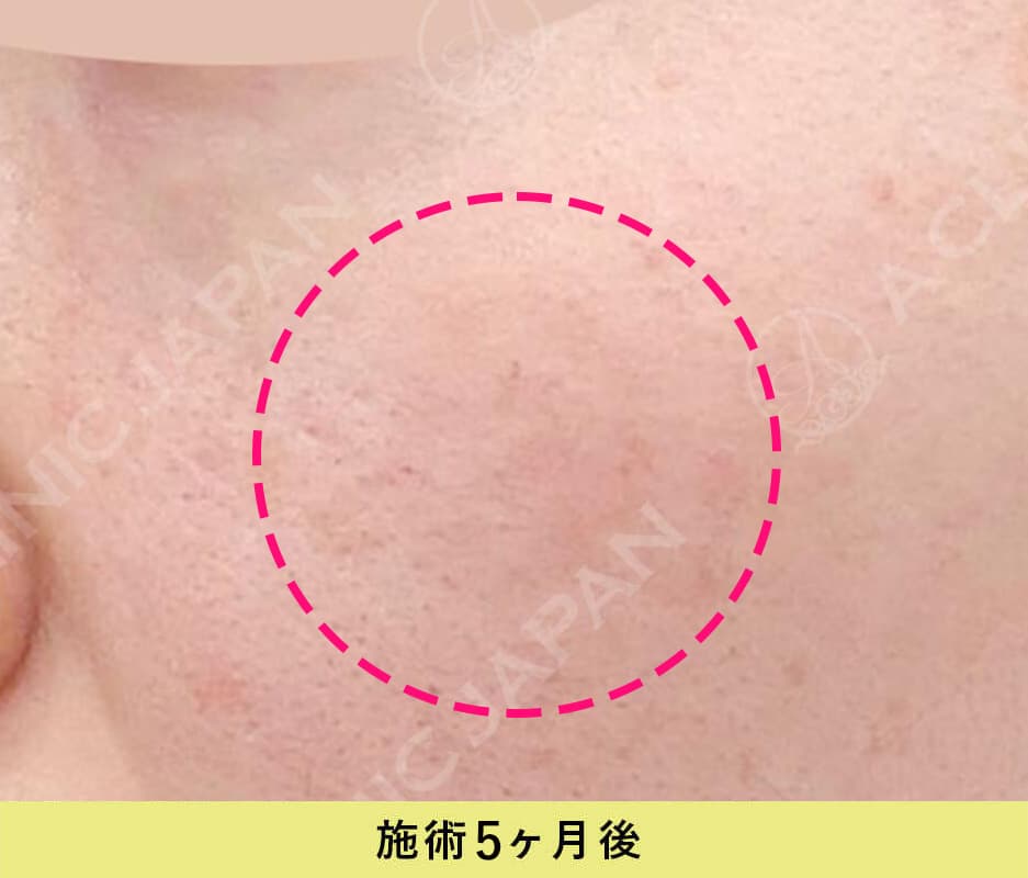 ピコスポット症例写真施術1ヶ月後