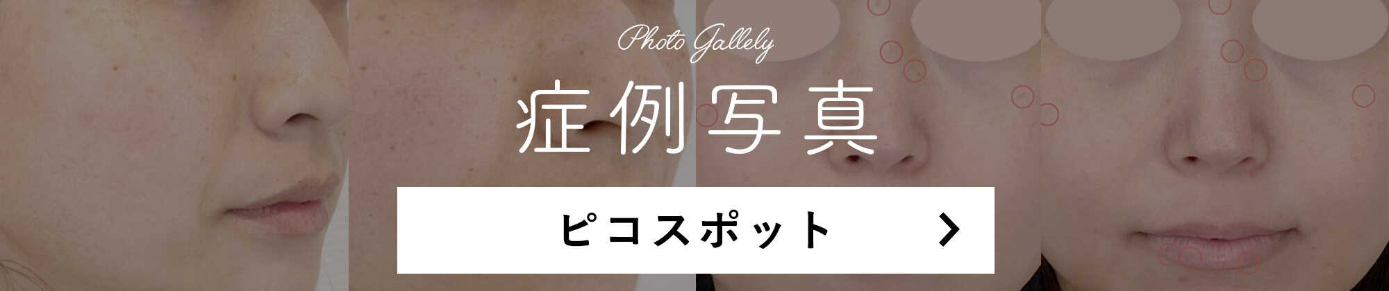 ピコスポットの症例写真はこちら