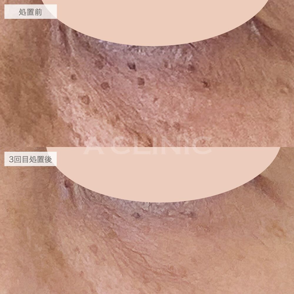 ピコレーザーの症例写真