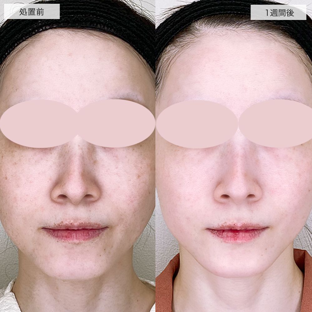 ピコレーザーアの症例写真