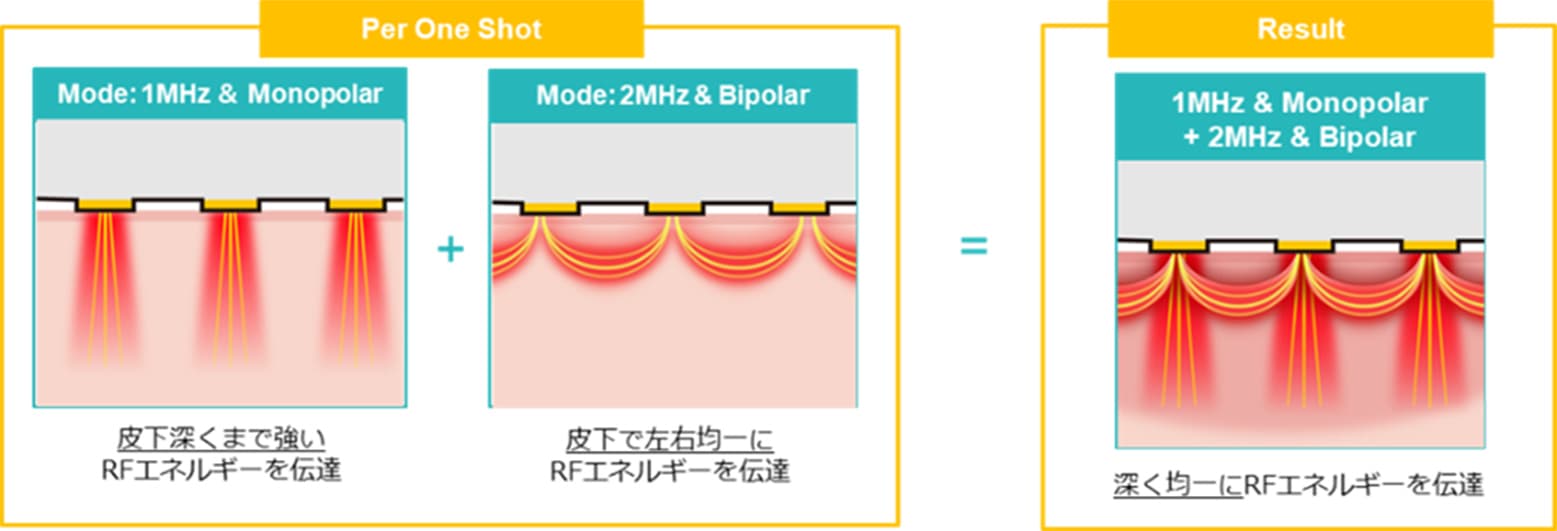 痛みやダウンタイムが少ない