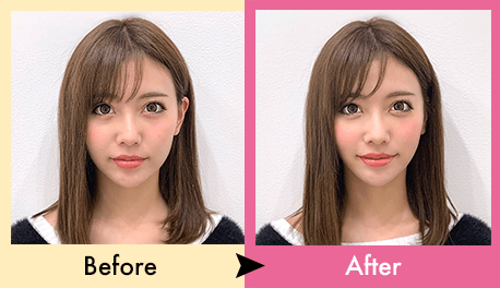 Aスレッド症例
