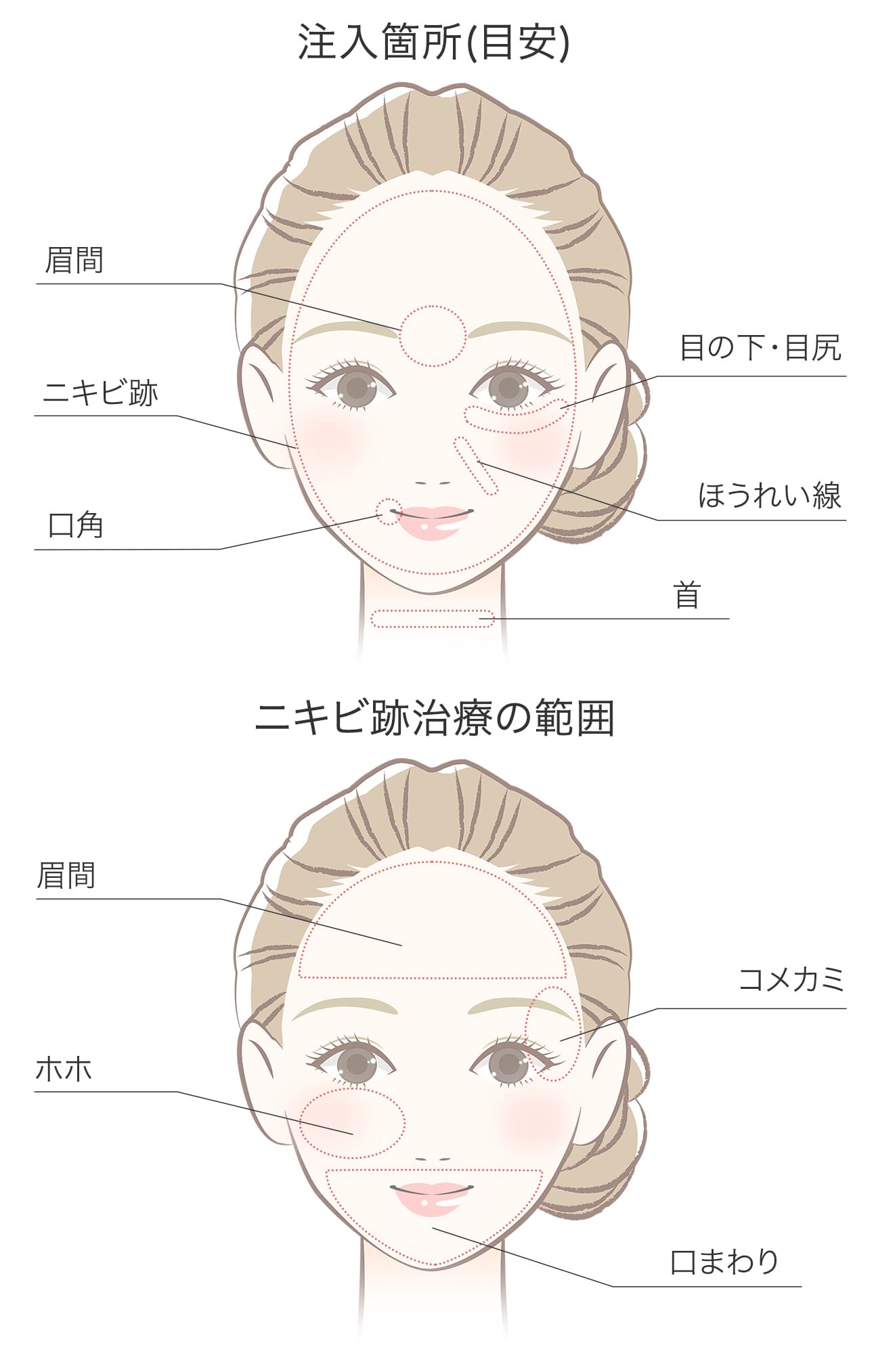 PRP血小板療法