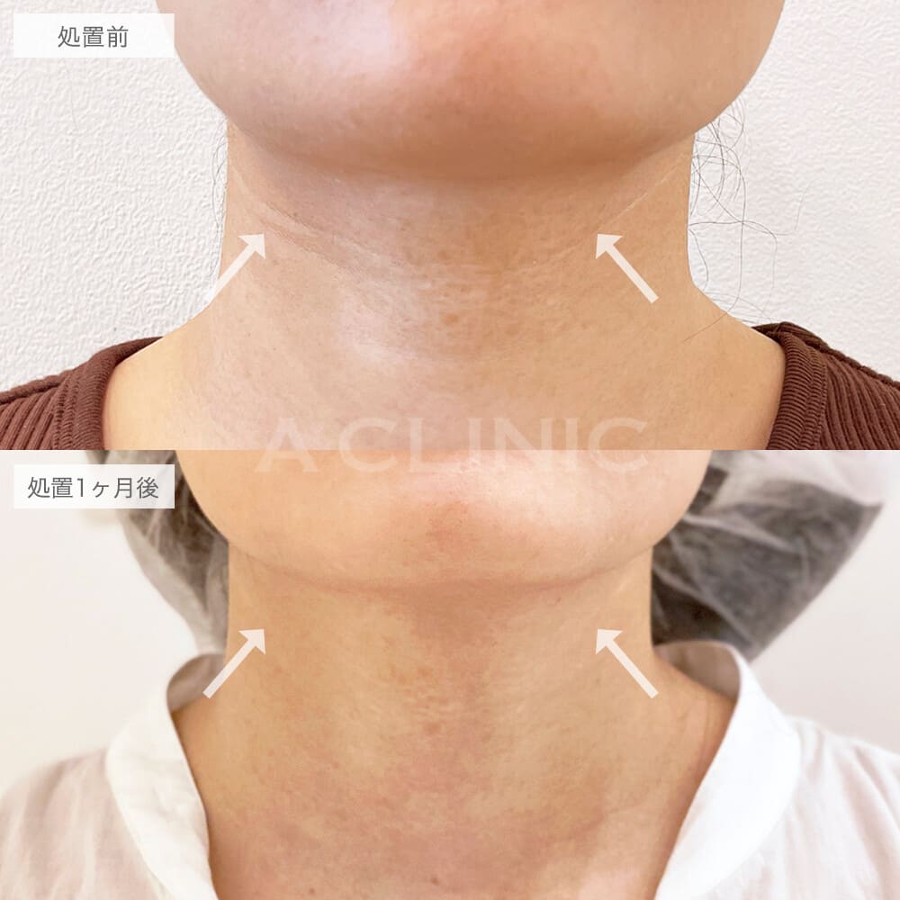 PRP血小板療法の症例写真