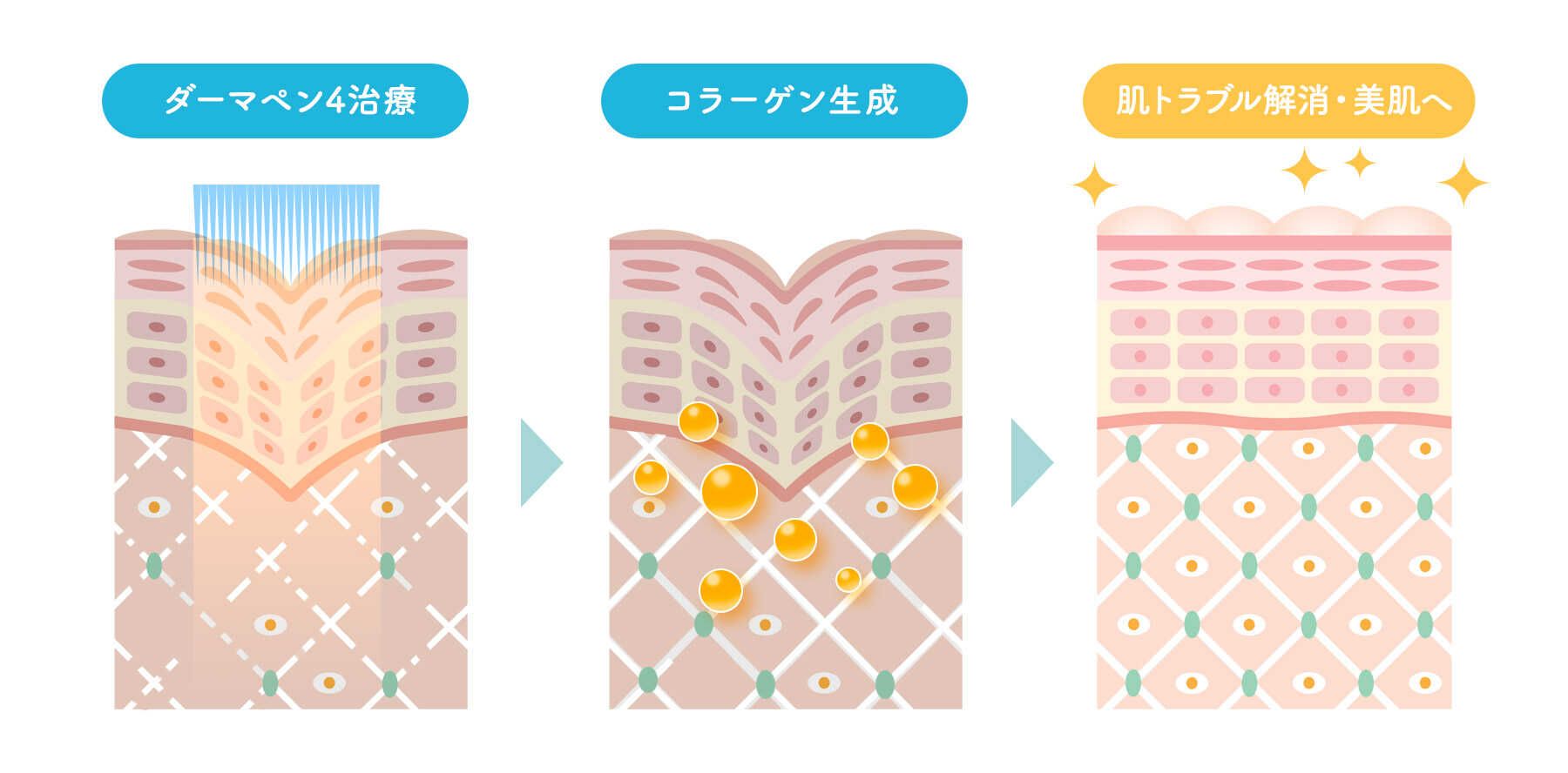 ダーマペン4改善効果