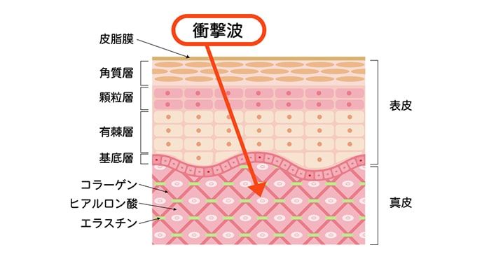 ピコフラクショナルの治療効果