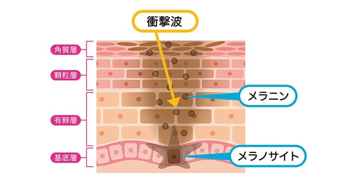 ピコトーニングの治療効果