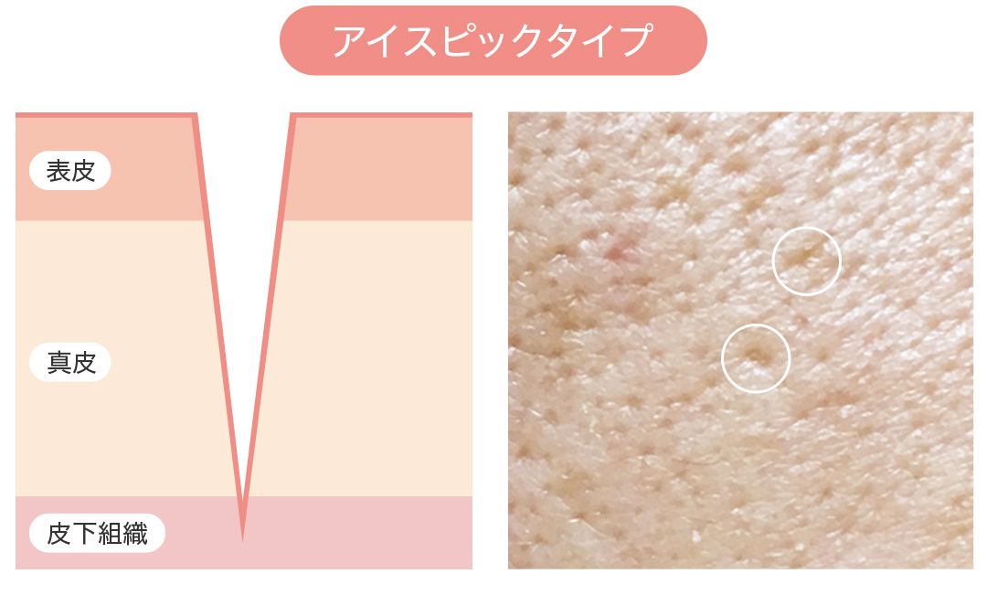 ニキビ跡の種類:アイスピック型