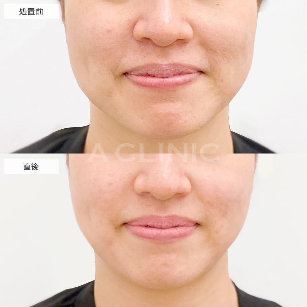 脂肪溶解HIFU(ハイフ)の症例写真