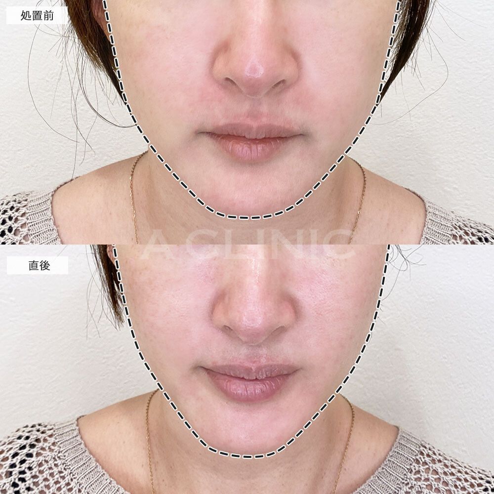 脂肪溶解HIFU(ハイフ)の症例写真