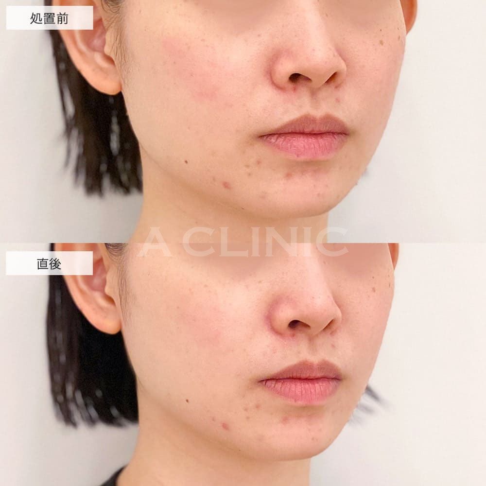 脂肪溶解HIFU(ハイフ)の症例写真