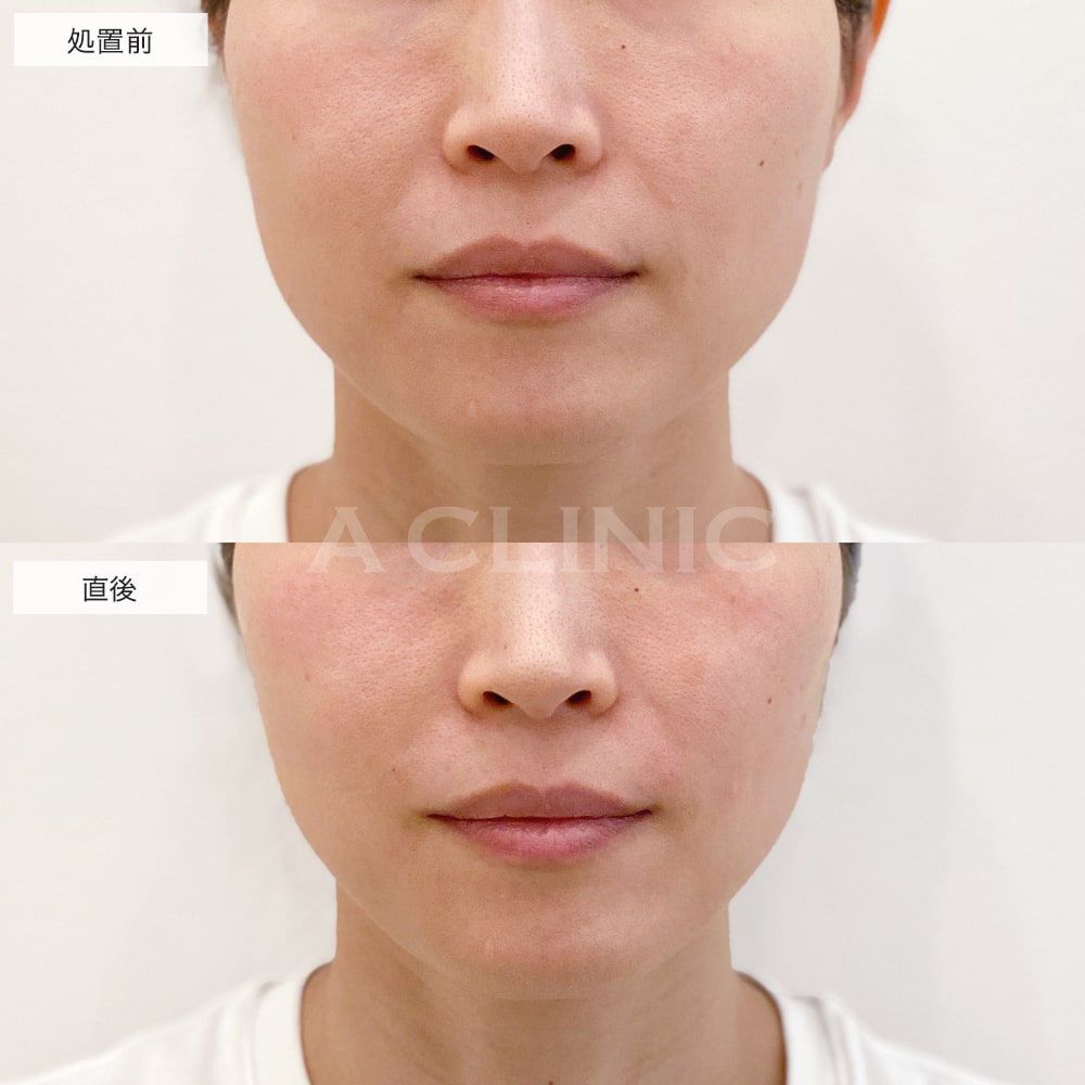 脂肪溶解HIFU(ハイフ)の症例写真