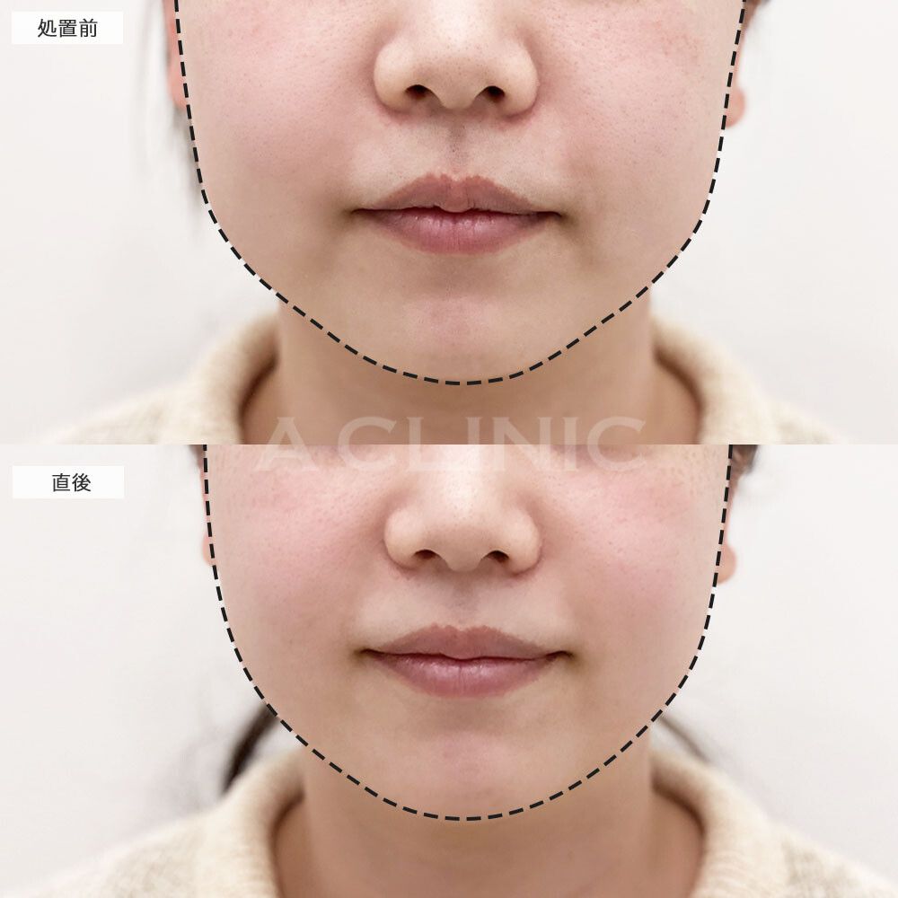 脂肪溶解HIFU(ハイフ)の症例写真
