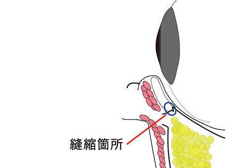 施術イメージ