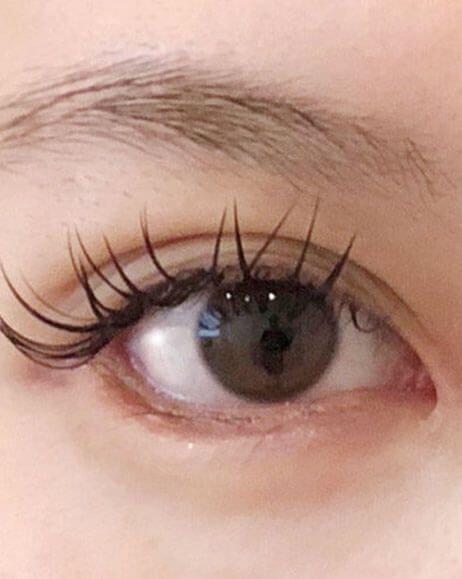 たれ目形成術(クイック法)術後