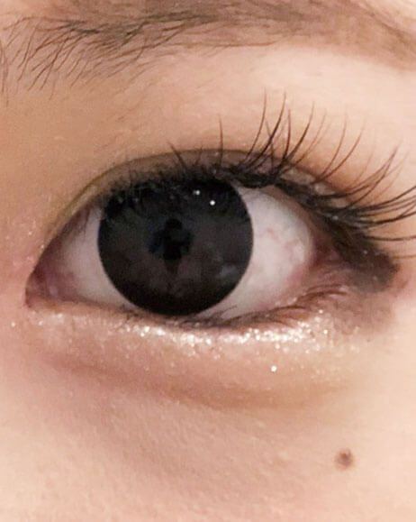たれ目形成術(クイック法)術後