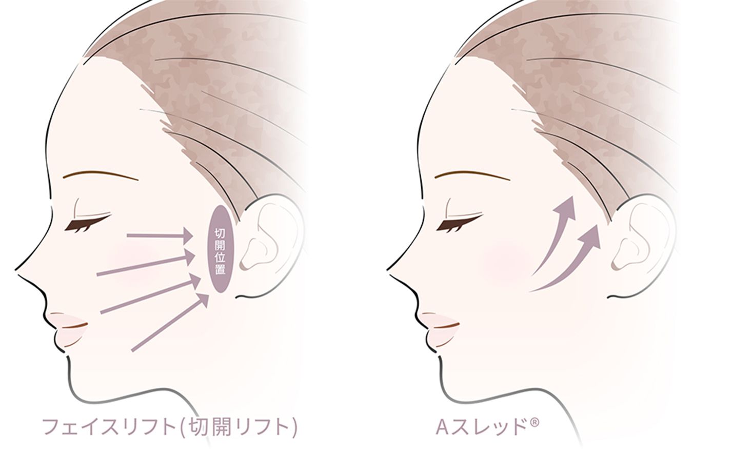 A式美肌たるみ切開の効果