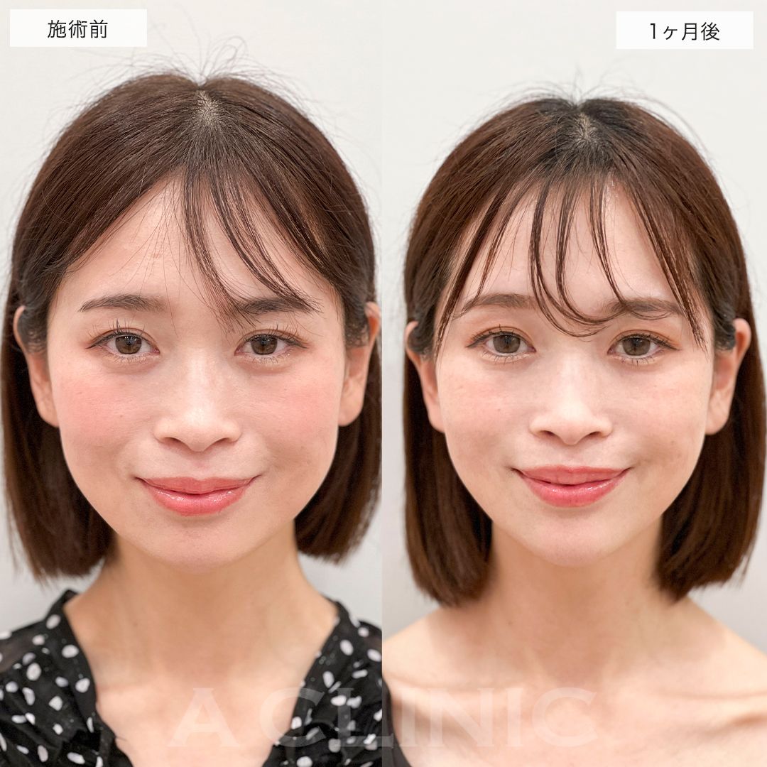 A式美肌たるみ切開の症例写真
