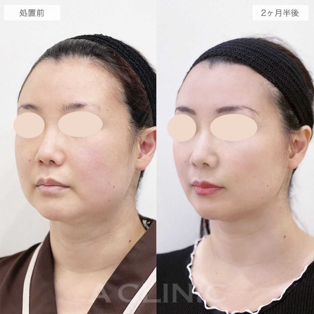 A式美肌たるみ切開の症例写真