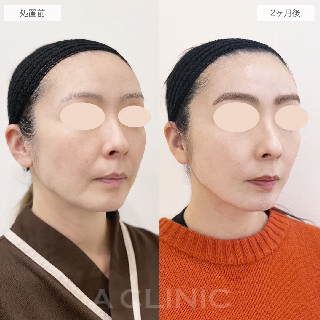 A式美肌たるみ切開の症例写真