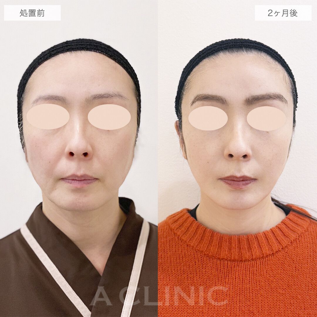 A式美肌たるみ切開の症例写真
