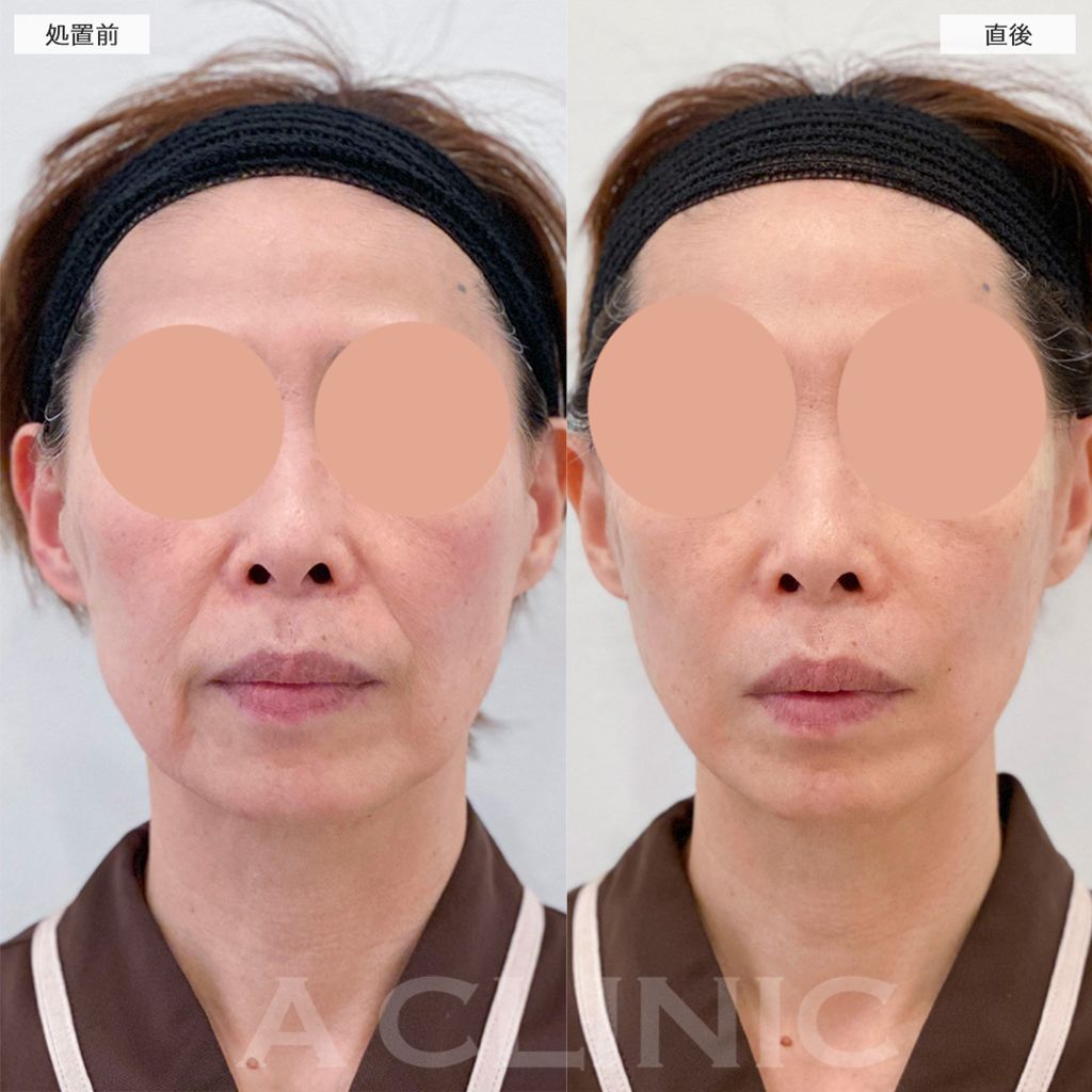 A式美肌たるみ切開の症例写真