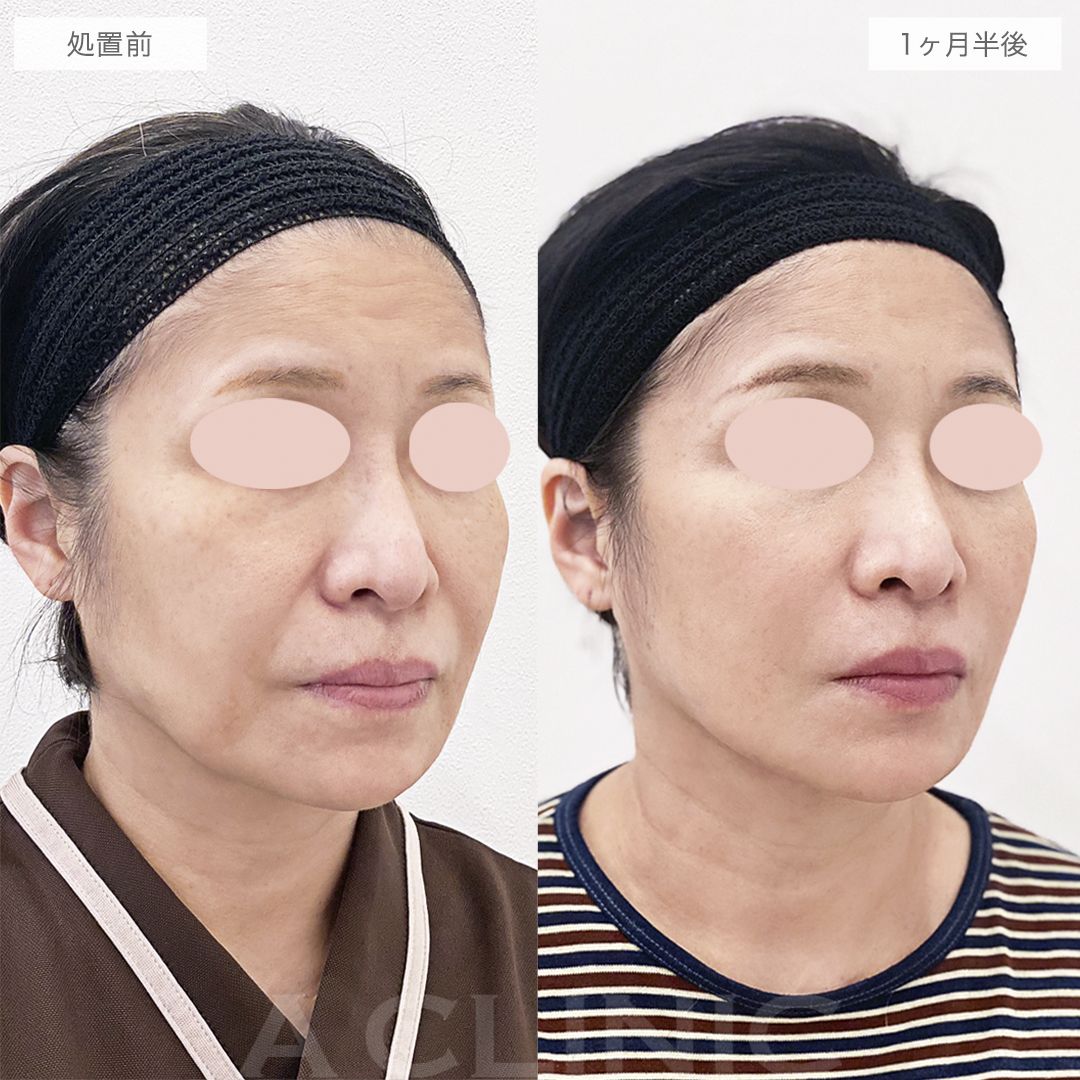 A式美肌たるみ切開の症例写真