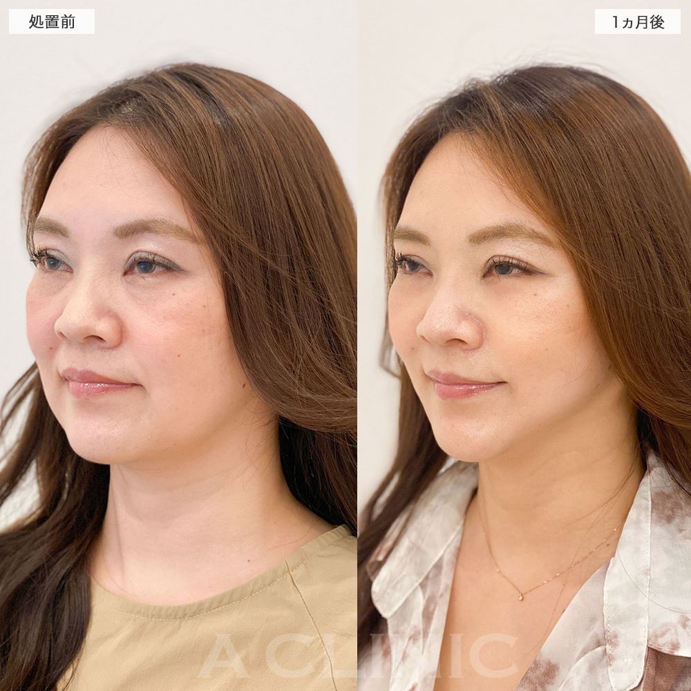 A式美肌たるみ切開の症例写真