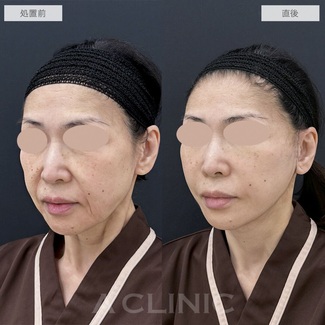 A式美肌たるみ切開の症例写真