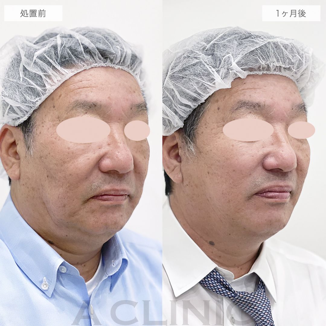 A式美肌たるみ切開の症例写真