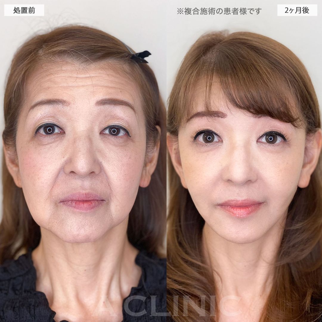 A式美肌たるみ切開の症例写真