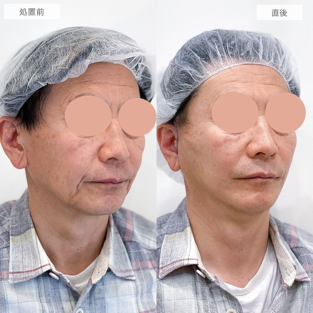 A式美肌たるみ切開の症例写真