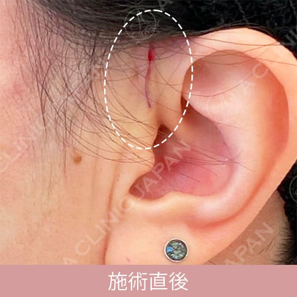 A式美肌たるみ切開の直後の傷跡の写真