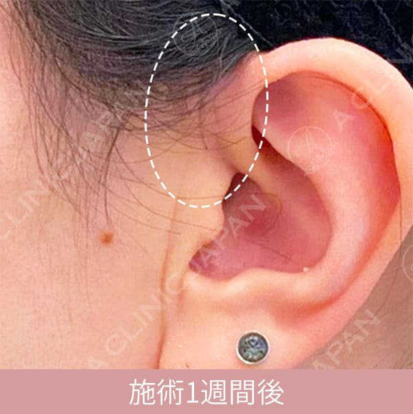 A式美肌たるみ切開の1週間後の傷跡の写真