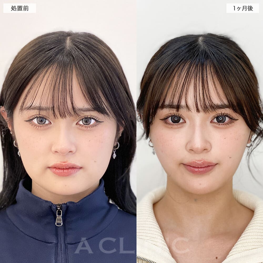 1day小顔脂肪吸引症例写真1サムネイル