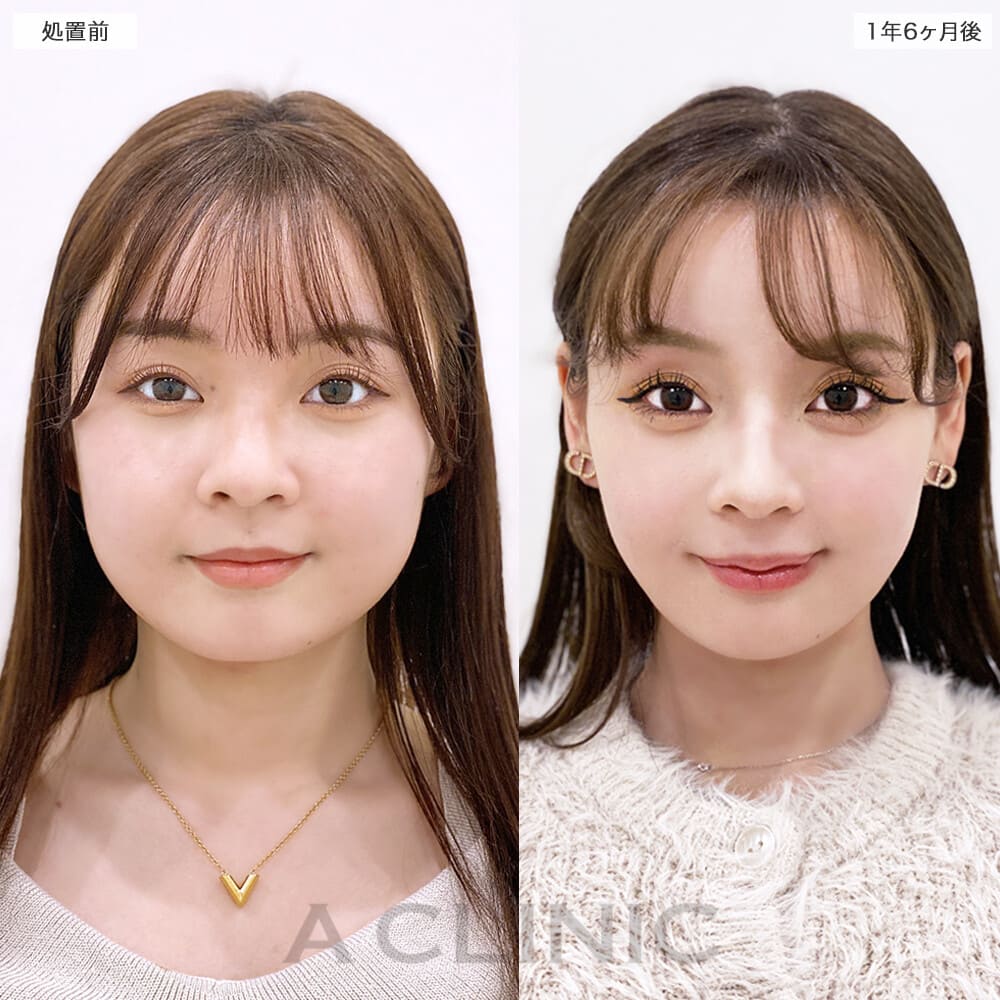 1day小顔脂肪吸引症例写真2サムネイル