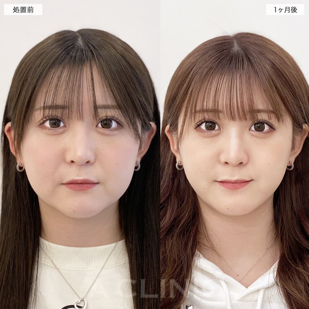 1day小顔脂肪吸引症例写真3サムネイル