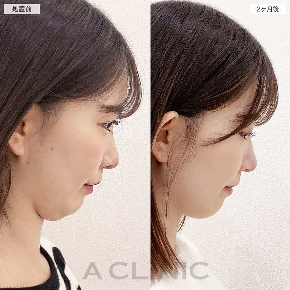 1day小顔脂肪吸引症例写真4サムネイル
