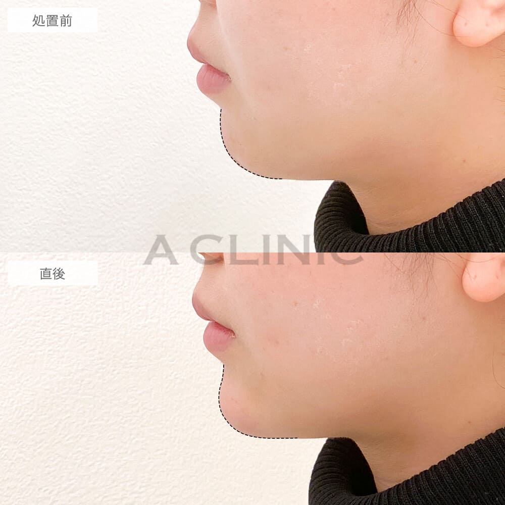 アゴのヒアルロン酸注入症例写真1サムネイル