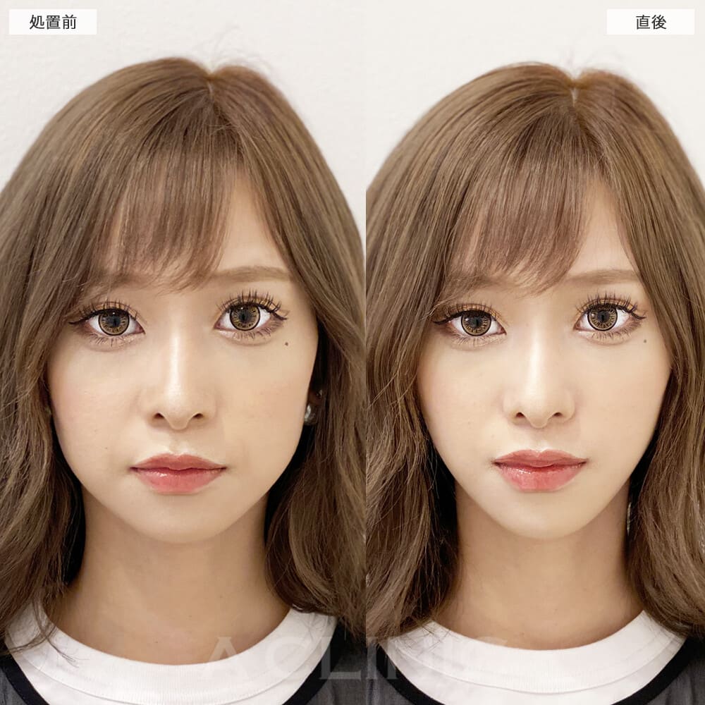 Aスレッド症例写真1サムネイル