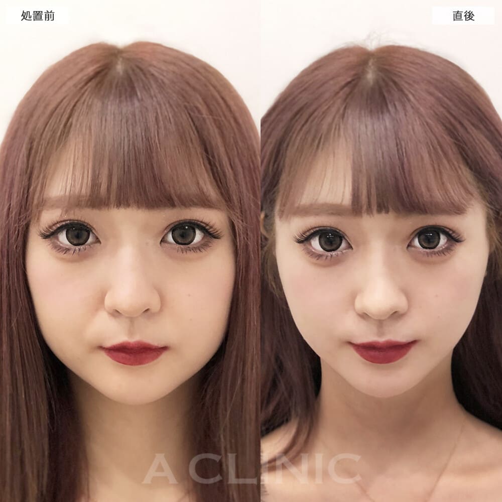 Aスレッド症例写真2サムネイル