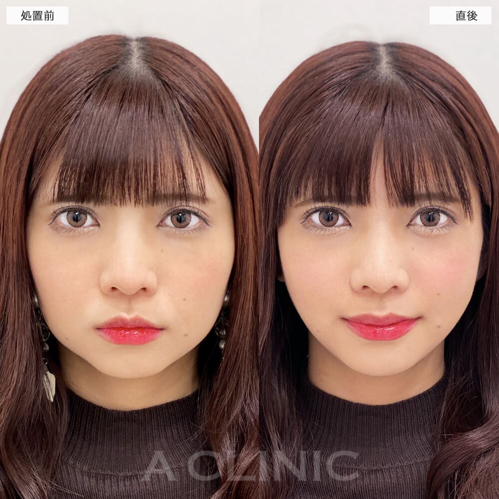 Aスレッド症例写真3サムネイル