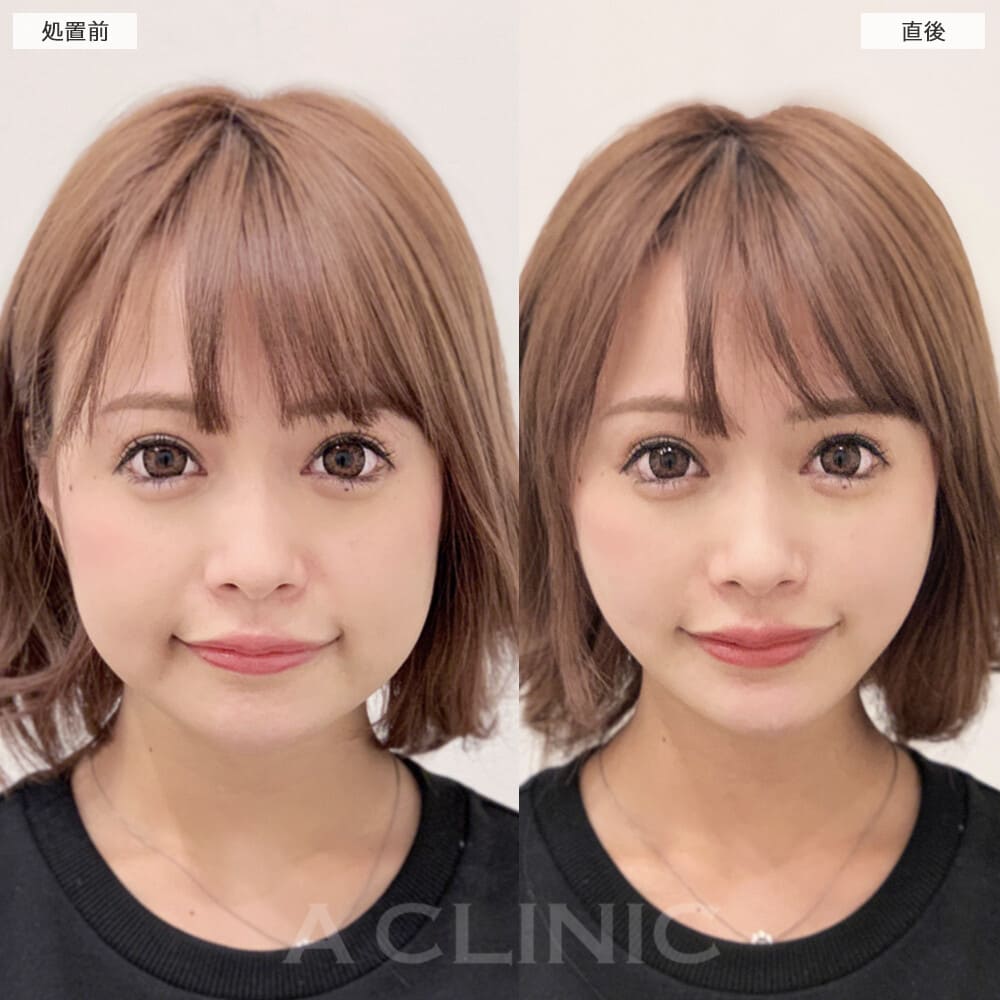 Aスレッド症例写真4サムネイル