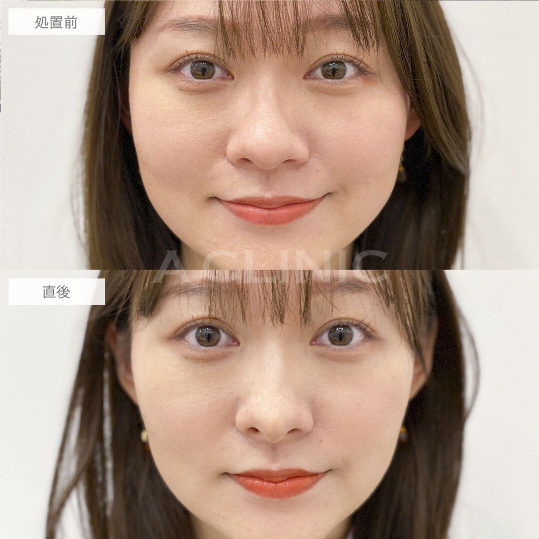コリアンノーズ/ジャスミンノーズ®︎鼻のヒアルロン酸)症例写真1サムネイル