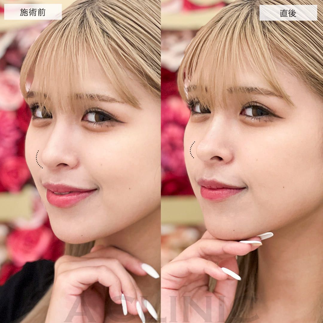 コリアンノーズ/ジャスミンノーズ®︎鼻のヒアルロン酸)症例写真3サムネイル