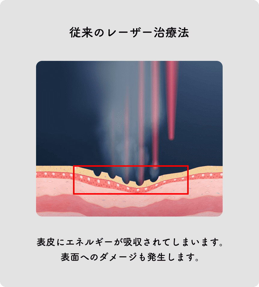 従来のレーザー治療法