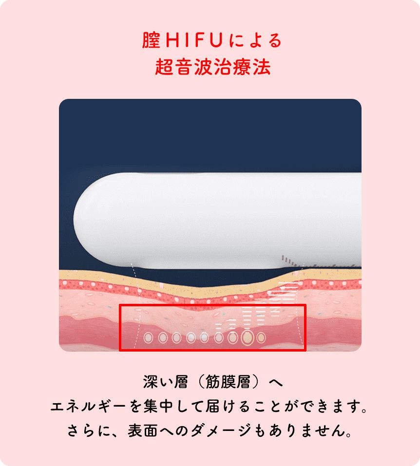 膣HIFU(ハイフ)による超音波治療法