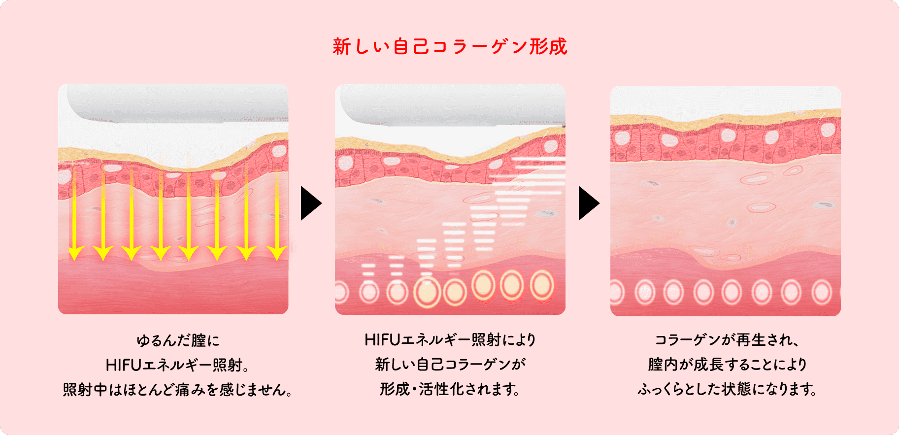 新しい自己コラーゲン形成
